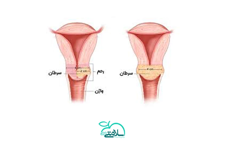 تمام آنچه که باید درباره سرطان فرج یا مهبل (پرینه) بدانید